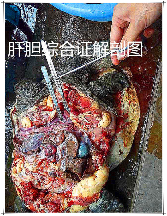 肝胆综合症