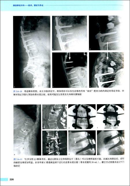 (AOSPINE)微创脊柱外科——技术、循证与争论 周悦主译 商品图2